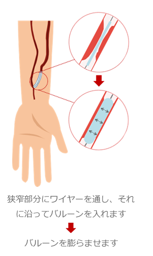 血管治療2